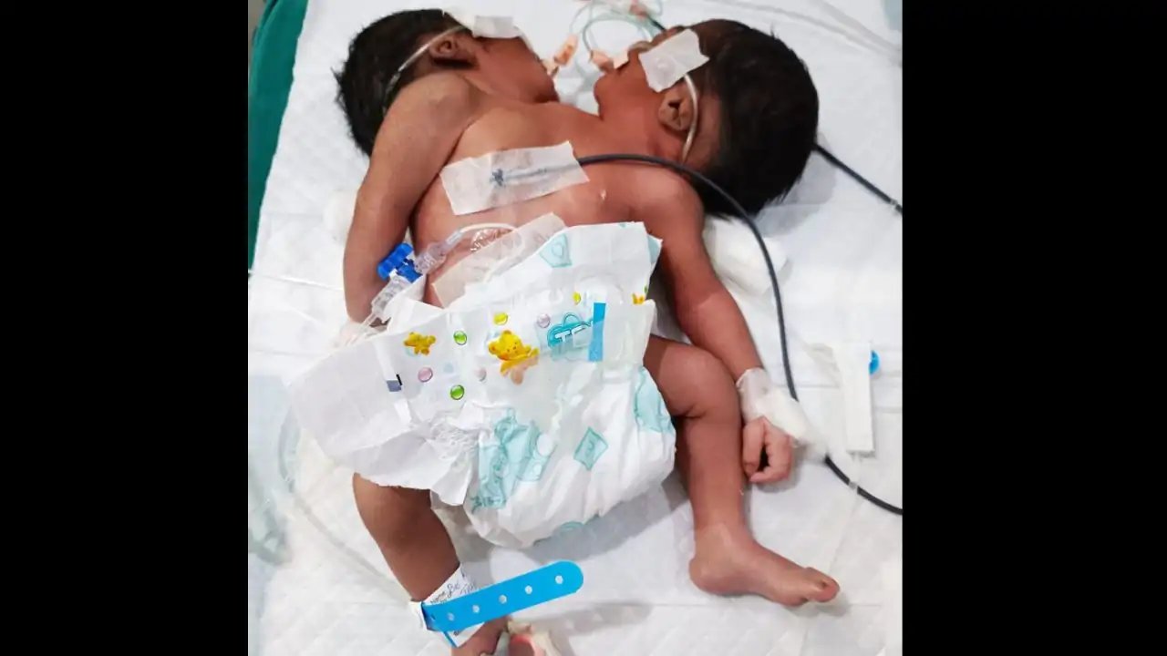 Odisha Mother Gives Birth to Twin‑Headed Baby, Hospital Stays on Edge