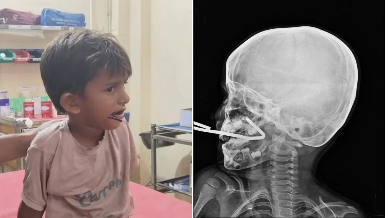 Five-Year-Old Survives Iron Rod Injury in Gujarat Village After 40-Minute Surgery