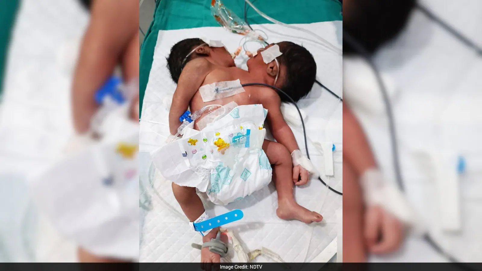 Rare Conjoined Twin Birth in Odisha Highlights Need for Early Prenatal Screening