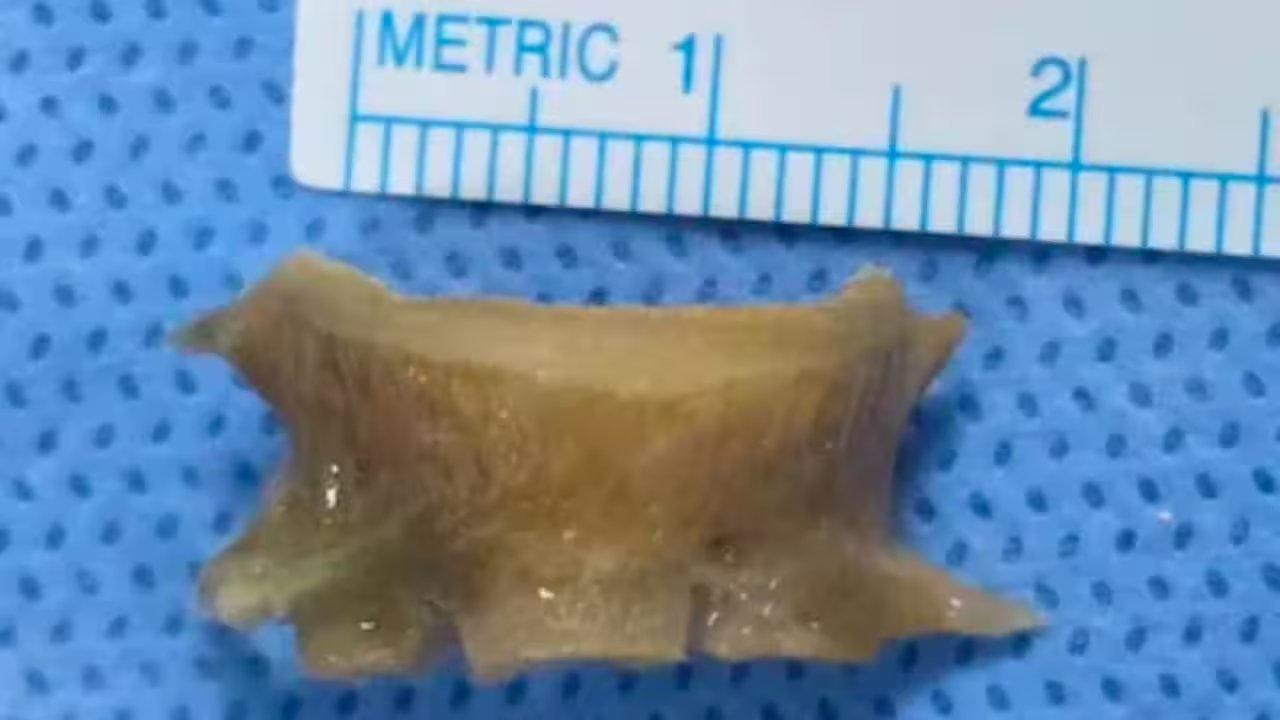 Sharjah Man Had 2cm Fish Bone In Airway For Two Months Before ER Doctors Removed It