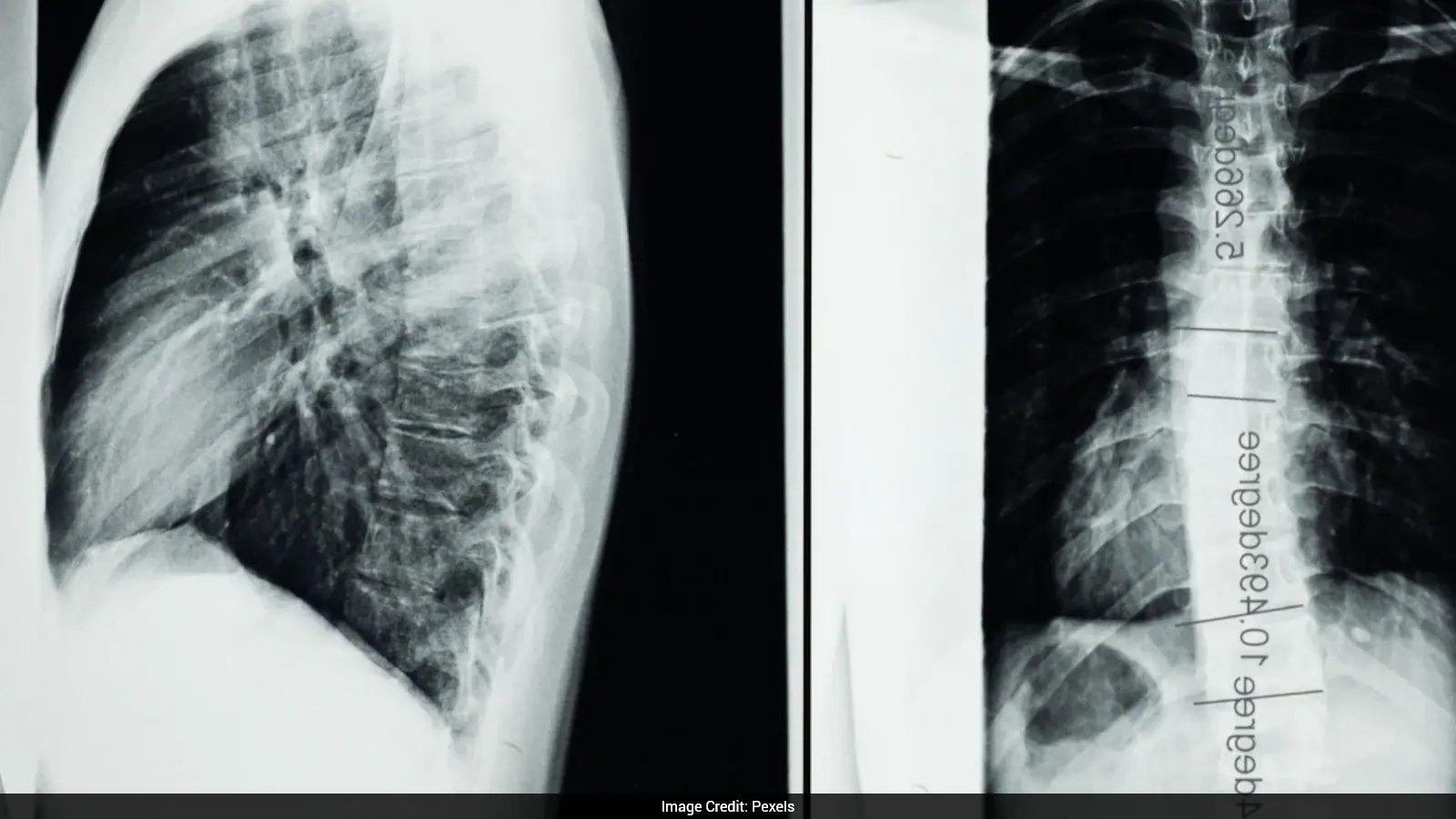 First Spinal Cord Transplant in Russia Yields Stable Recovery for Paralyzed Patient